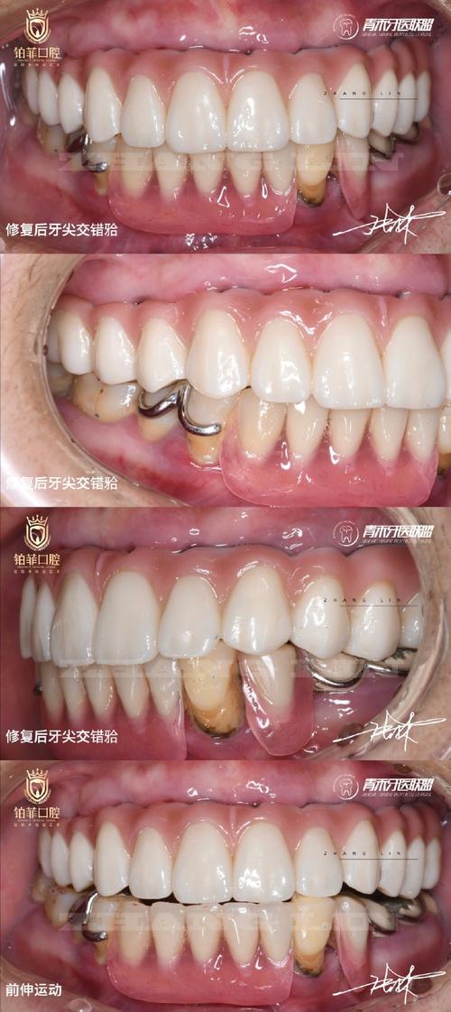 即刻负重种植牙用的植体为何能实现即刻负重？-图3