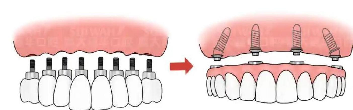 即刻负重种植牙用的植体为何能实现即刻负重？-图2