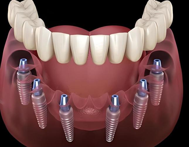 all-on-4植牙图包含哪些种植流程、技术要点及效果信息？-图2