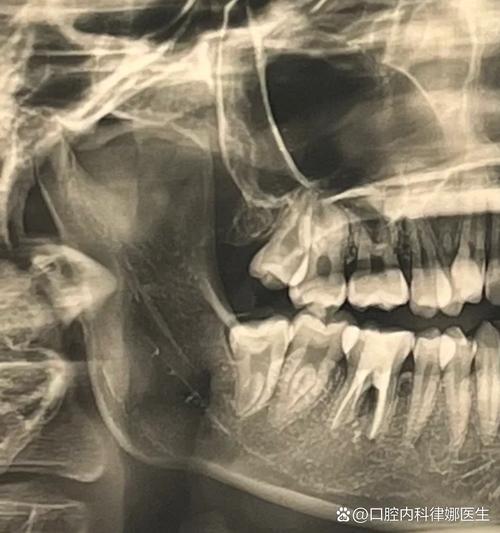 植牙是不是不能做 ct-图2