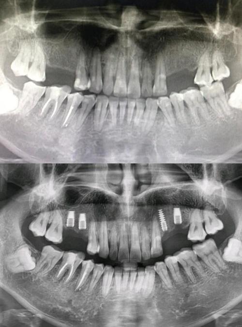 植牙是不是不能做 ct-图3