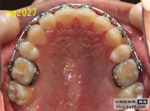 正畸带环传递方法如何规范高效操作？-图2