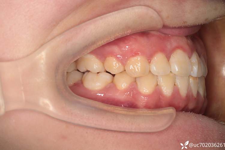 拔牙正畸真实案例,真的有必要吗?效果如何?-图2 拔牙正畸真实案例,真的有必要吗?效果如何?-图2
