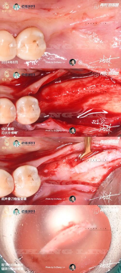 植牙骨粉掉出来了该怎么办?-图1 植牙骨粉掉出来了该怎么办?-图1