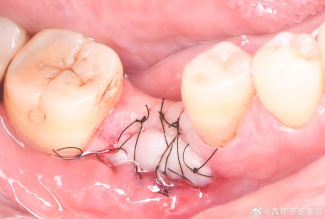 植牙骨粉掉出来了该怎么办?-图2 植牙骨粉掉出来了该怎么办?-图2