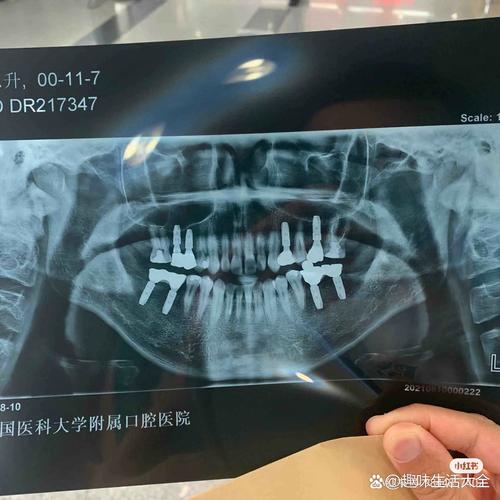 牙齿断了半截 能植牙吗-图3