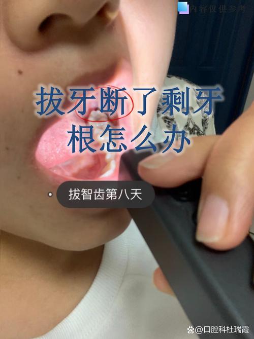 牙齿断了半截 能植牙吗-图2