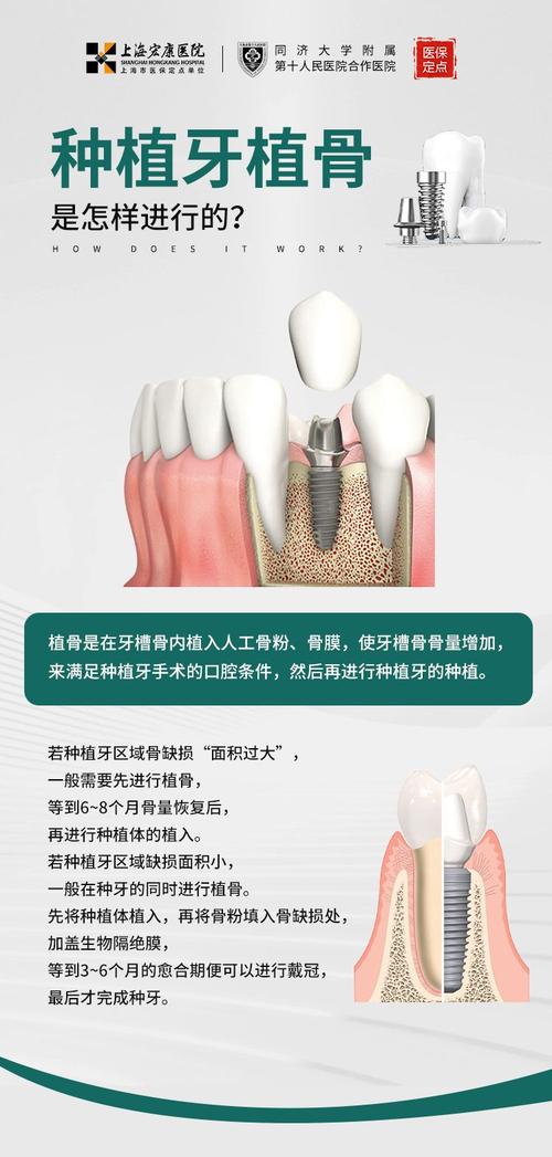 种植牙植体植入后，疼痛会持续多久？-图3