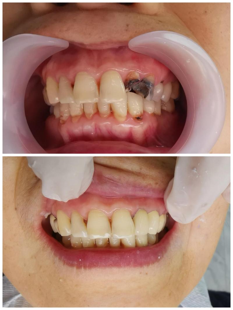 植牙或安装牙冠后牙齿痛,究竟是什么原因导致的呢?-图3 植牙或安装牙冠后牙齿痛,究竟是什么原因导致的呢?-图3