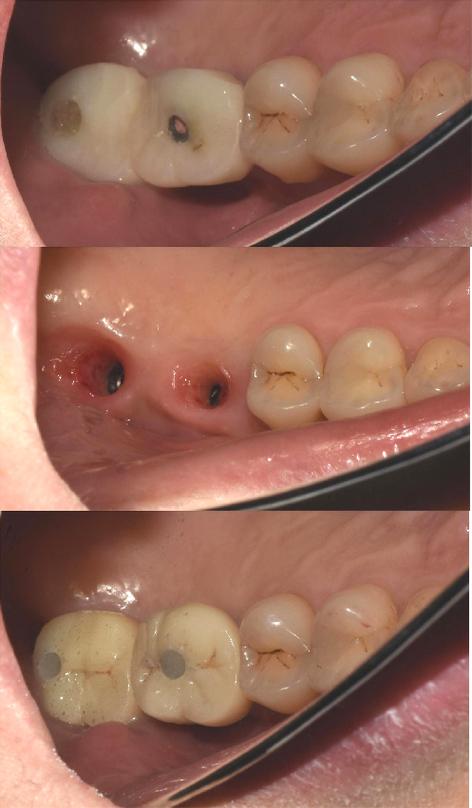 植牙或安装牙冠后牙齿痛,究竟是什么原因导致的呢?-图2 植牙或安装牙冠后牙齿痛,究竟是什么原因导致的呢?-图2