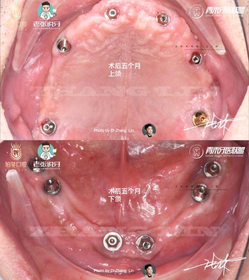 即刻负重植牙手术是什么？有何优势？-图3