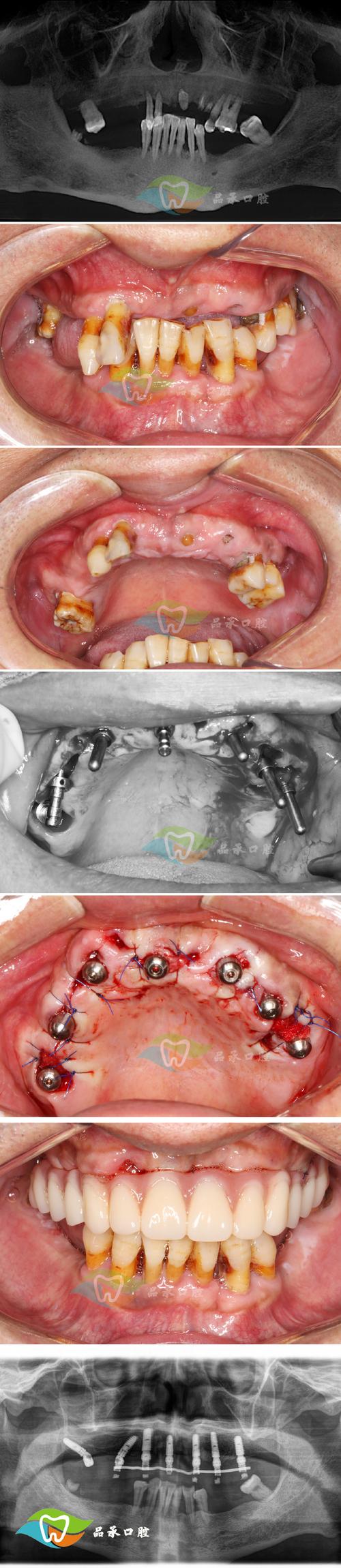 即刻负重植牙手术是什么？有何优势？-图1