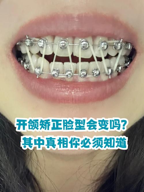 牙齿正畸影响咬合吗-图1