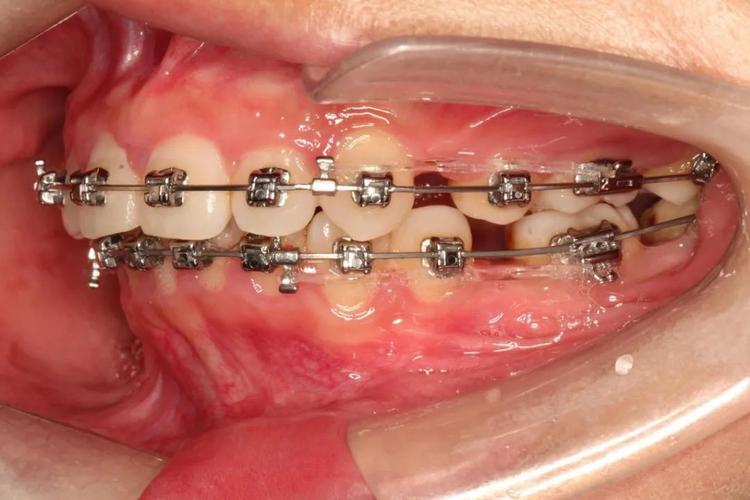 片段弓局部正畸视频-图2