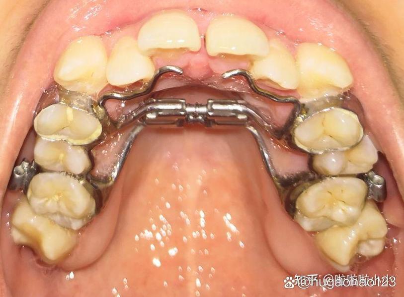 片段弓局部正畸视频-图3