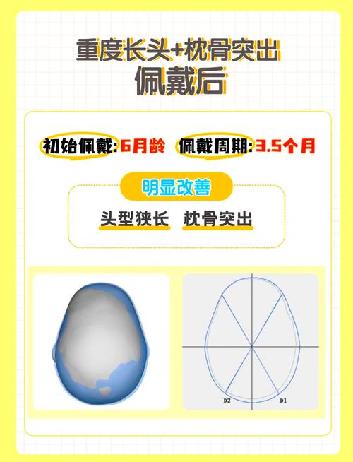 正畸头帽睡觉戴着到底舒服不舒服？-图1