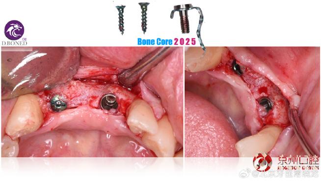 下颌前牙骨增量正畸-图1