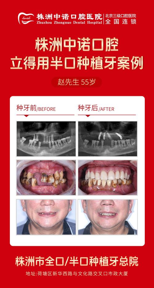 半口牙全缺失种牙，究竟要植几颗才够？-图2