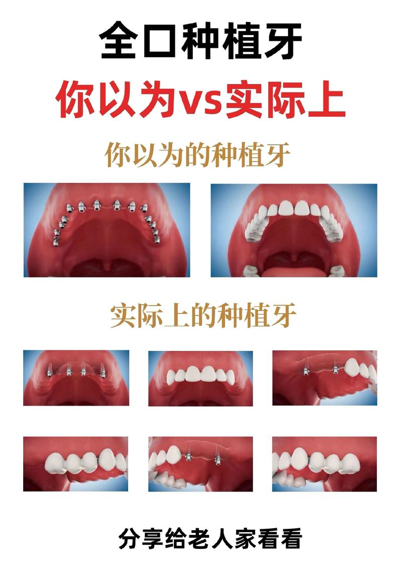 半口牙全缺失种牙，究竟要植几颗才够？-图1