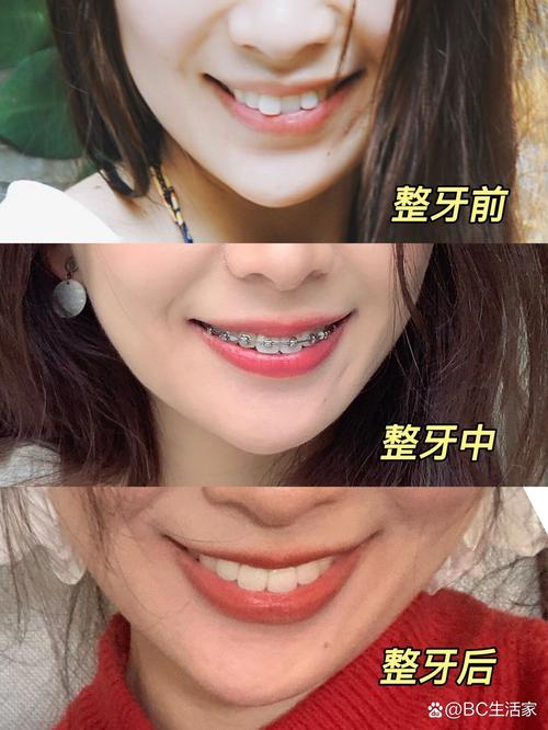 口腔正畸怎么算失败-图2