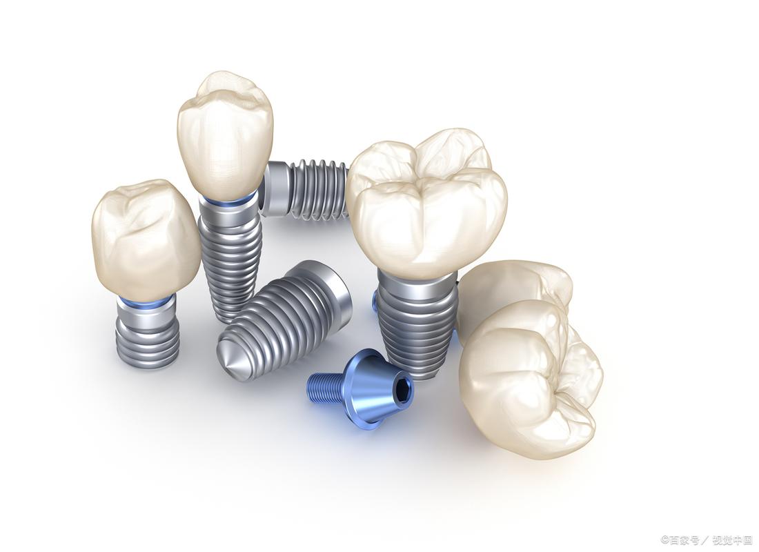 北京种牙首选e德贝植牙-图3
