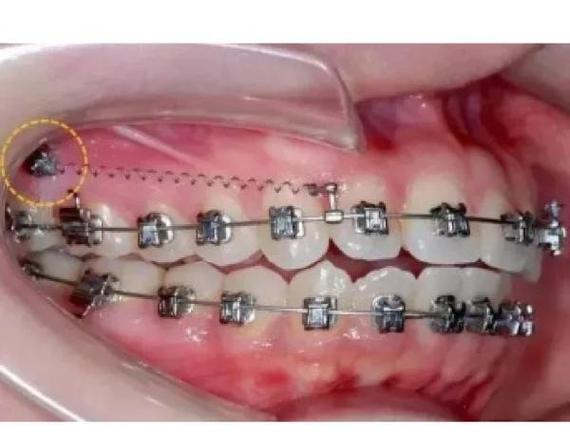 正畸生理性支抗技术相较于传统支抗有何独特优势？-图2