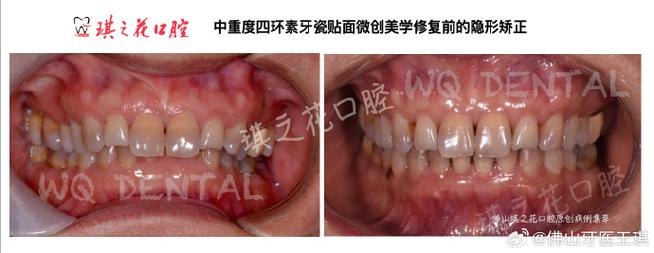 正畸后前牙咬合很紧-图2