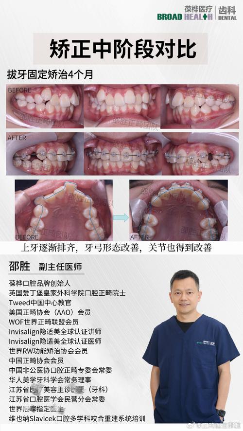 前牙美学正畸治疗，如何兼顾美观与功能达到理想效果？-图3