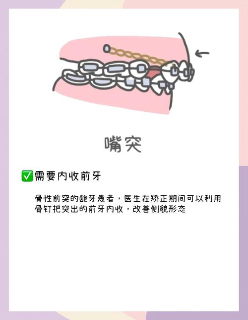 正畸种植钉矫治效果怎样?操作体会、难点及注意事项有哪些?-图2 正畸种植钉矫治效果怎样?操作体会、难点及注意事项有哪些?-图2