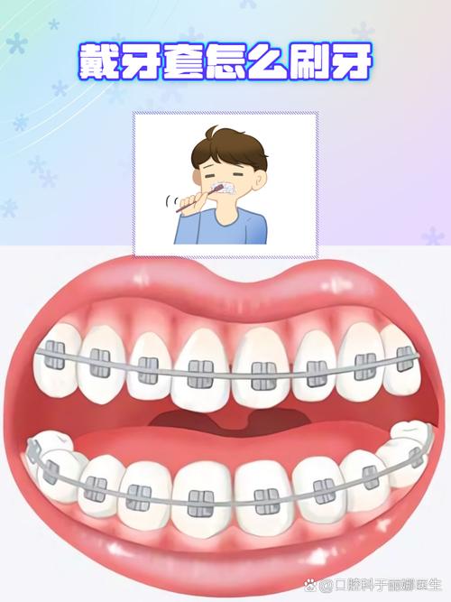 正畸上班怎么刷牙？公司里的牙套清洁实用方法-图1