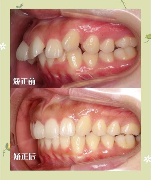 正畸 整体前移后牙-图3
