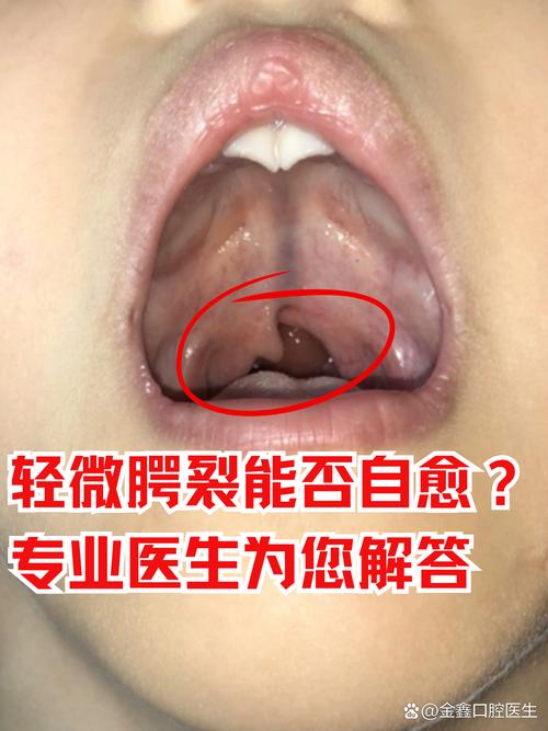 腭裂患者能做正畸治疗吗？-图1