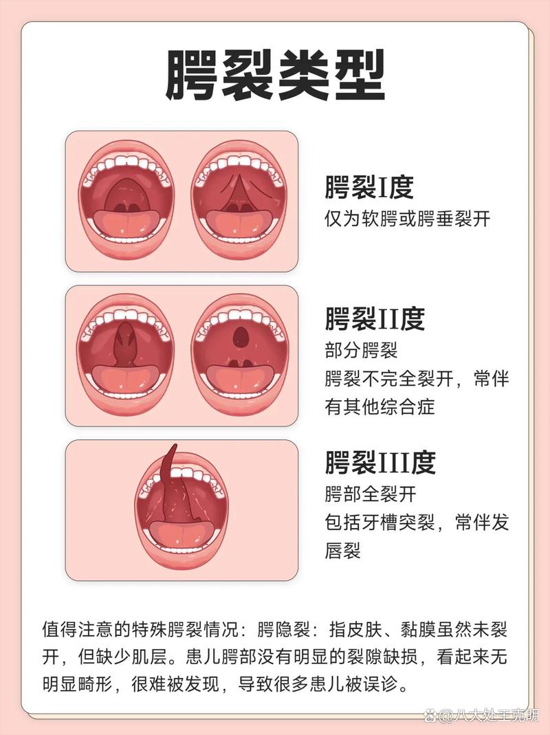 腭裂患者能做正畸治疗吗？-图2