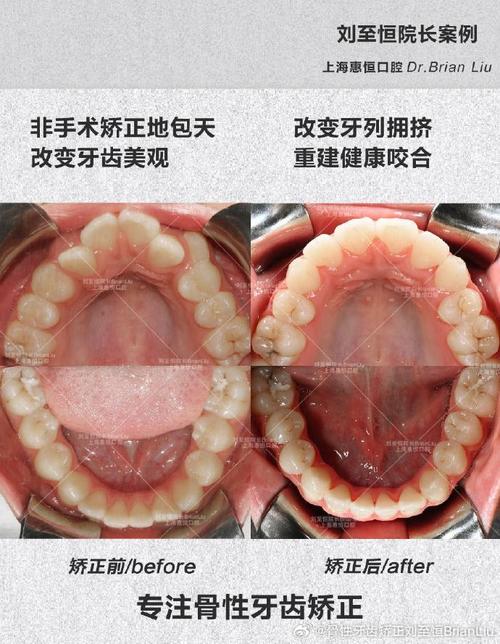 上海去哪里牙齿正畸-图1