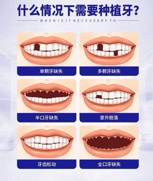 植牙后会出现哪些不适应症状？-图1