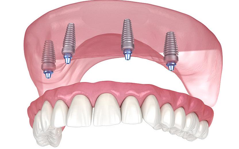 美国3i植体系统种牙效果如何？有哪些优势？适合哪些人？-图3