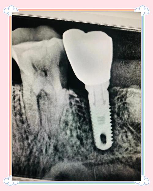 植牙后 看不见种植体-图1