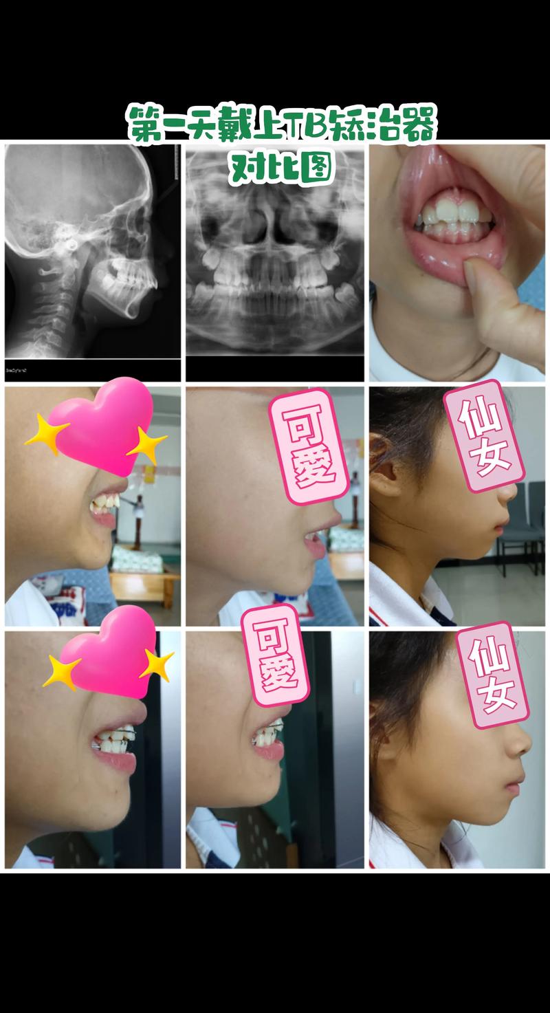 mbt正畸技术发展-图2