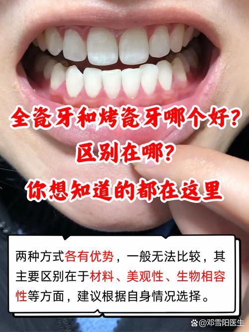 重植牙和烤瓷牙哪个好？选哪个更合适？-图2