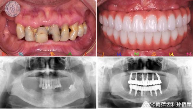 新植的牙咬合时有点碰-图3