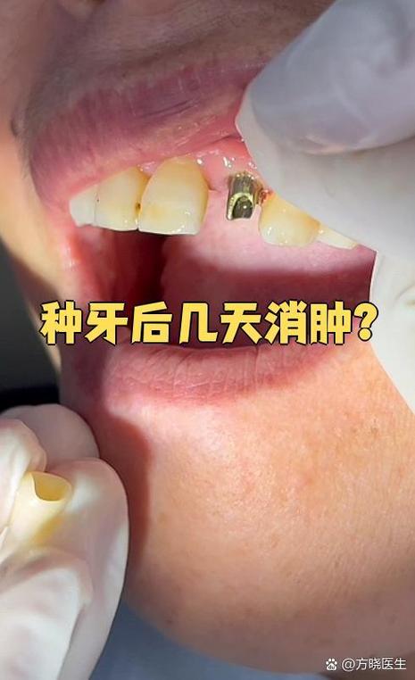 植牙手术一个星期后牙龈仍有点肿,这是正常反应吗?需要就医吗?-图1 植牙手术一个星期后牙龈仍有点肿,这是正常反应吗?需要就医吗?-图1