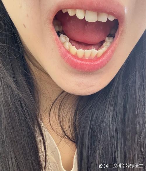 植牙骨后有洼坑正常吗-图2