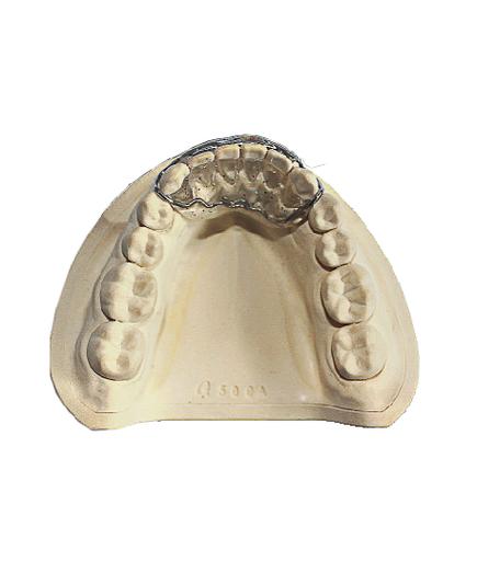 牙齿正畸装弹簧，究竟有何矫正妙用？-图2