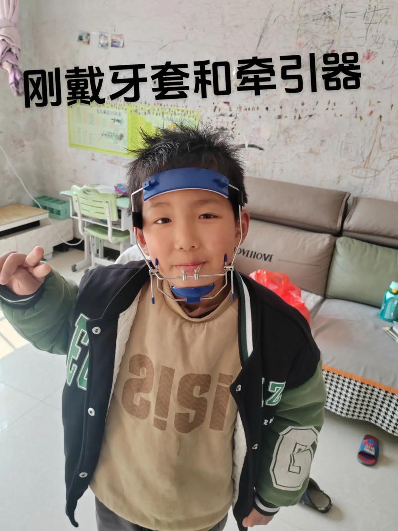 正畸颌间343牵引，343代表什么？牵引机制与效果如何？-图1