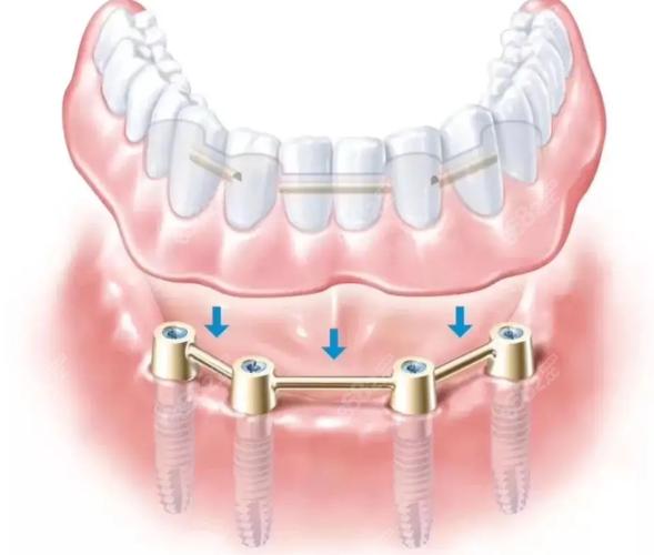 all-on4种植牙-图3
