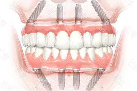 all-on4种植牙-图2
