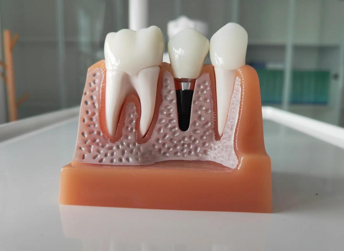 位置窄种植牙种细植体-图1