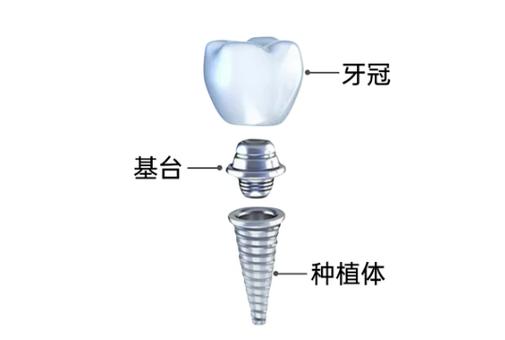 位置窄种植牙种细植体-图2