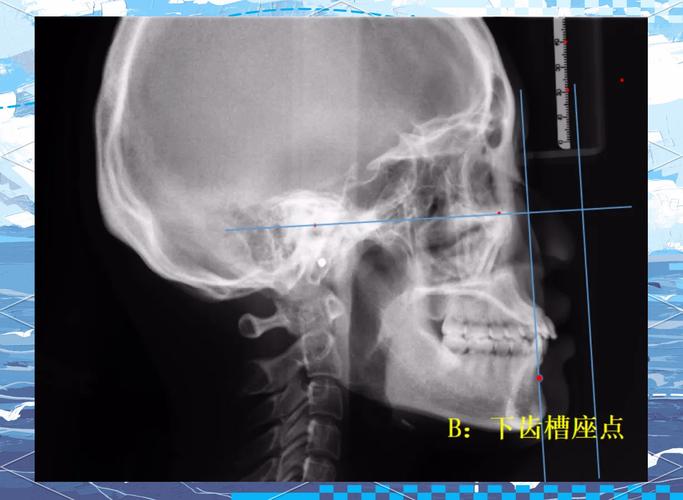 正畸anb角是什么-图2