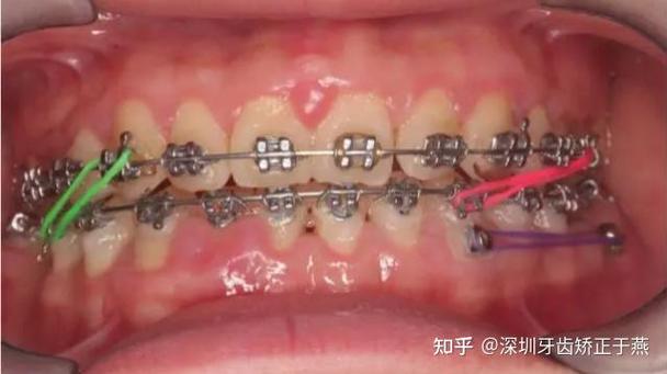 正畸颌间牵引分几类-图3